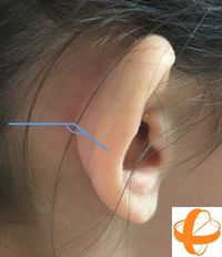 Un corrector invisible para disimular las orejas de soplillo 