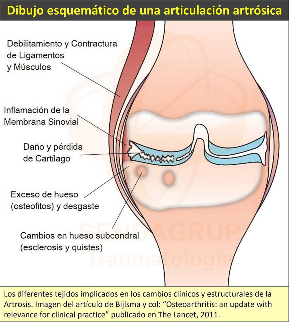 Desgaste de rodilla  Dr. Manrique Ávila