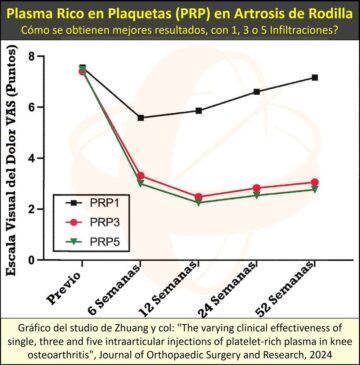 El tratamiento de la Artrosis ded Rodilla mediante 3 Infiltraciones de Plasma Rico en Plaquetas (PRP) es el más aconsejable